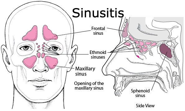 Sinus Causes Symptoms Diagnosis And Treatment Astor Otolaryngologist